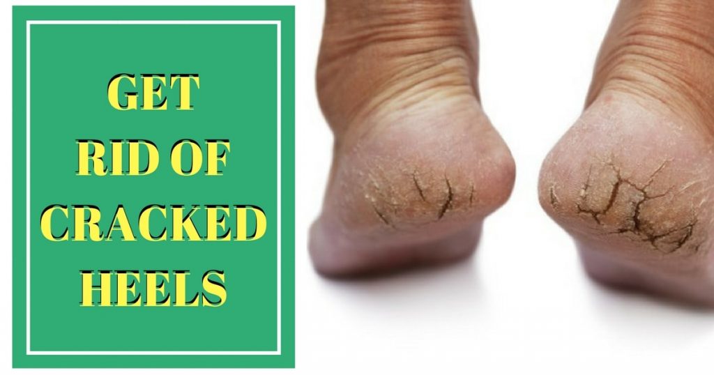 Best Tips For Treating Cracked Heels Using Home Remedies – Jithya Blog